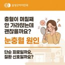 삼성굿아이안과의원 | 눈충혈원인, 단순 피로일까? 계속 붉다면 확인해야 할 이유 (수원삼성굿아이안과)