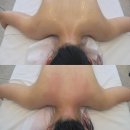 명지 등관리 맛집 화문에스테틱 솔직후기 전후사진