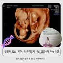 쌍둥이 임신 14주차 니프티검사 10번 삼염색체 이상소견, 입체초음파결과 및 양수검사 예약 후기