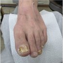 장대 | 진주 하동 발톱무좀 관리샵 소개받아 방문한 후네일 &amp;베어진주장대점 솔직후기