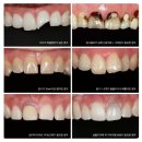 구본석치과의원 | [공지] 미금역치과 이빨 부러짐 앞니 브릿지 후기