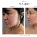 천안 불당동 : 불당동 윤곽관리 에스테티아 추천 솔직후기, 무보정 기본카메라