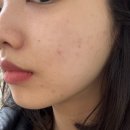 수연한의원 | 청주 복대동 지웰시티 피부관리실 이룸 에스테틱 여드름 관리 후기