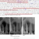 신경치료에 대해 제대로 알고 계신가요? / 레진, 신경치료부분/ 봉선연합치과