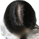 1·3 달고식품 | 여자 탈모 극복 로게인폼 한달 3개월 반년1년 사용 솔직 후기 (꿀팁 부작용 내돈내산)