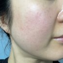 아우라의원 | 압구정 피부과 튠페이스 받은 일주일차 후기