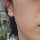 오송2산단 피부과 더순수의원 골드테라피 내돈내산 후기