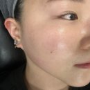 초이스뷰티 | 구래동 피부관리 초이스뷰티 콜드플라즈마 물방울 리프팅 관리 후기
