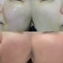 럭셔리뷰티별가람점 | 청담피부과 스킨튠업 피코토닝 클라리티 미백 맞춤시술 후기