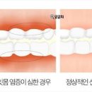 잇몸 혀 구내염 증상과 원인 전염이 될까? 빨리 낫는 법 이미지