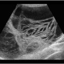 Malignant ovarian lesions 이미지