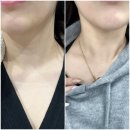 웰라스피부과의원 | 대치동 피부과추천 웰라스피부과의원 목주름필러 후기+