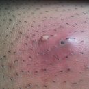 [혐주의]Ingrown hair(내생모,매몰모) 이미지