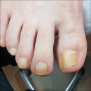 반송동210 | 동탄 반송동 내성발톱 부모님발관리 제대로 시켜드리기 네일포유