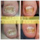벧엘동물병원 | 일산치유본의원 [파주][삼송]직업군인 부부의 발톱무좀 치료 후기, 아이까지 전염될까 두려웠어요…