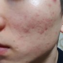 사계절한의원 | 여드름흉터한의원 깊이 모양에 따라 맞춤 관리 후기