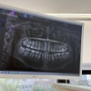 잠실숲사랑니구강악안면외과치과의원 | [공지] 구강악안면외과 추천 잠실숲사랑니치과 한 번에 3개 발치 성공 솔직 후기 (사진 有)