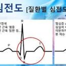 심전도 검사 방법 및 결과 시간 병원 이상 소견 이미지