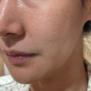 새살침 1회차 후기, 멍 붓기 이정도. 내돈내산 후기 (RF 니들)