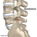 Spondylosis, Spondylolysis, Spondylolisthesis 에 대한 지식교환 이미지