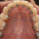 드림라인치과교정과치과의원 | 비대칭 재교정, 투명교정 실패 후 설측교정으로 개선한 후기. 잠실 교정치과