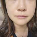 강남 피부관리 토닝레이저 하러갔다 악센토 한 후기