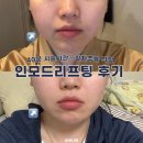 포마티 | 인모드리프팅 FX포마 꼼꼼하게 40분 진행하는 압구정역 피부과 전후 비교 후기