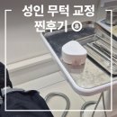 미소정형외과의원 | 성인무턱교정 후기 ⑧, 무턱양악 아닌 비수술 교정 후기, 7~8개월차