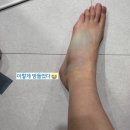 임신30주차🤰 발목삐어서 정형외과 가다. 임산부엑스레이/반깁스