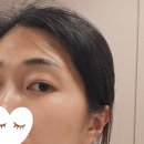 프라이덴 덴탈 랩 | 대구중구피부과에서 리즈네 스킨부스터 2cc 맞은 후기