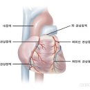 죽상동맥경화증 이미지