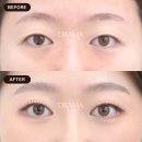 양빛나유외과의원 | 20대 눈밑지방재배치, 퀭한 눈매를 생기 있게 | 1개월 경과 후기 (드라마성형외과)