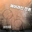 선헤어라인 이미지