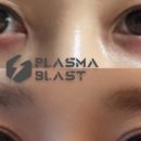 콜드플라즈마 이미지