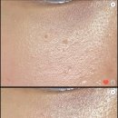 건강튼튼의원 | 자연튼튼의원 편평사마귀 제거 후기