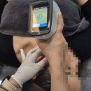 (주)이수카본 | 흑자 제거, 흑자 레이저 - 리팟레이저 후기
