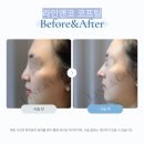 라인앤코 | [강남 코끝 실리프팅] 라인앤코 코프팅 후기｜자연스러운 코끝 높이와 옆라인 변화