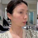 빠른케어성동사업소 | 성수역 피부과 속건조 완벽하게 잡는 승무원 스킨부스터 [콜라스터 올인원] 직후사진 후기