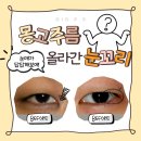 D&A(디앤에이)성형외과의원 | 지오성형외과 앞트임 뒷트임 꼭 같이 해야하는지 알고 싶다면
