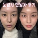 드라마성형외과의원 | 30대 눈밑지 후기, 드라마성형외과에서 다크서클 탈출하고 광명찾음
