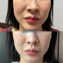 청담피부과 쥬베룩 볼륨 후기 4살은 어려진 느낌,,?!맞쥬