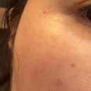 삼주한의원 | 상계동한의원 패인흉터 새살침 눈밑흉터 눈옆흉터 후기