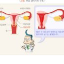 자궁 자궁내막증 및 원인, (임신, 생리통, 성교통증장애) 이미지