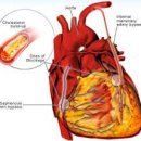 관상동맥 우회술[coronary artery bypass graft] 질환이란? 이미지