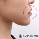 김태우치과의원 | 설측교정, 주걱턱이 좋아질 수 있을까요? (30대 여자분 3급 부정교합 치료 후기)