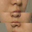 센텀시티역 | 부산 센텀시티역피부과 팔자주름 개선 미희주사 내돈내산 후기