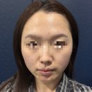 에스테티아전주완산 | 윤곽관리 5회 받으면 효과있을까? [에스테티아 전주완산1호점] 전후 비교 후기
