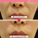 대구 성인봉합 성형외과 어디로 가야 할지 고민하고 계시나요? (사례)