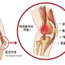 장경골띠증후군(iliotibial band syndrome), 장경인대증후군 이미지