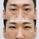 리미트성형외과의원 네이버블로그